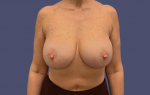 Breast Lift w/Fat Transfer 1 Before